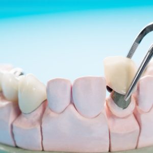 Dental crowns and bridges