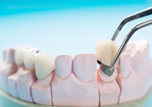 Dental crowns and bridges