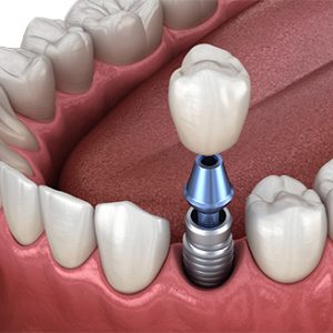 Dental implant