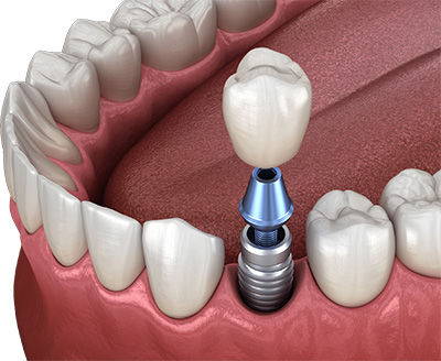 Dental implant