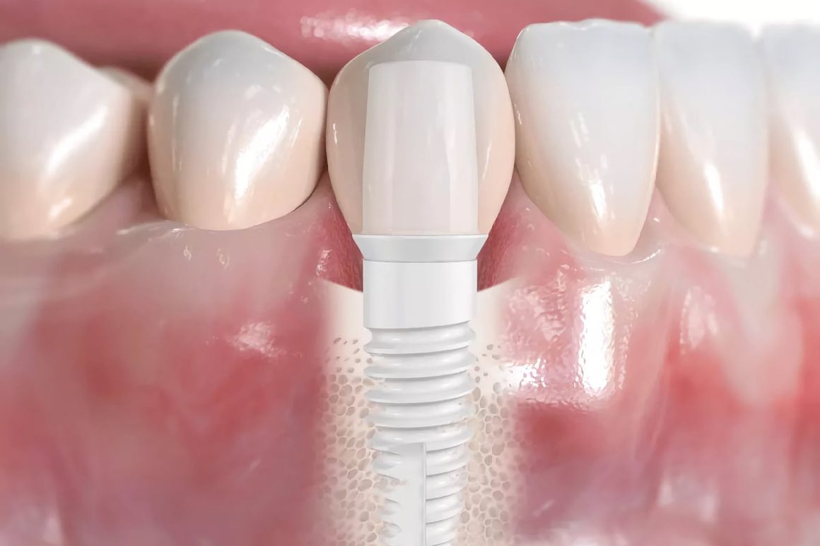 What makes ceramic implants increasingly popular?