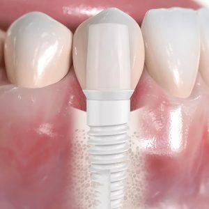 What makes ceramic implants increasingly popular?