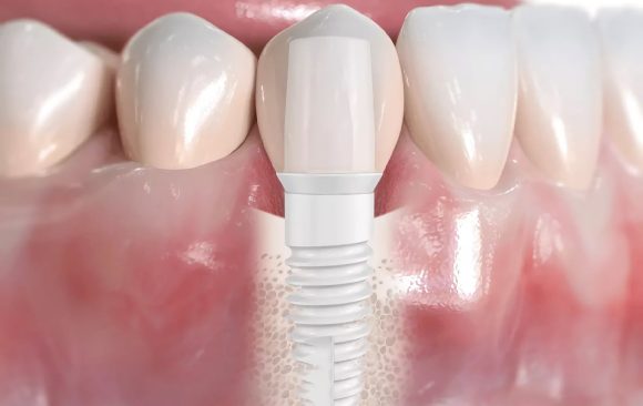 What makes ceramic implants increasingly popular?